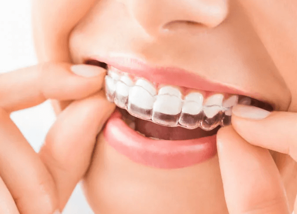 The Benefits of Clear Aligners for Correcting Crooked Teeth